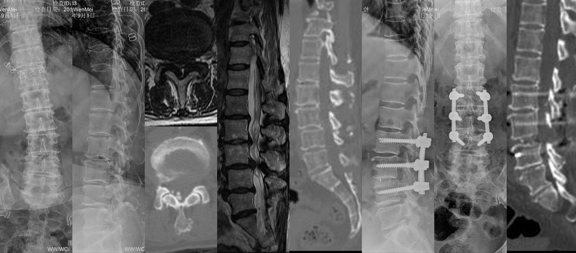 腰椎管狹窄減壓植骨融合內固定術（女，67）.jpg