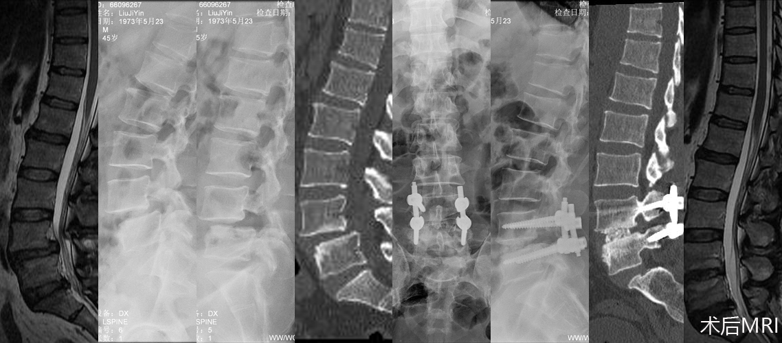 腰椎滑脫后路復位減壓植骨內固定術（男，45歲）.jpg